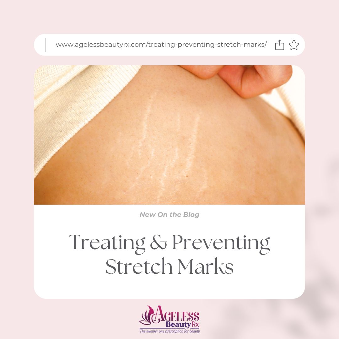 Treating & Preventing Stretch Marks